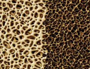 Some Individuals Are More Prone to Develop Osteoporosis • Treatments to Stop Bone Loss