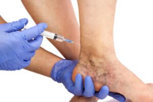 Benefits of Undergoing Sclerotherapy Treatment for Spider Veins in Raleigh Spider Vein Treatment