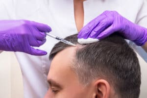 PRP For Hair Loss How Does It Compare To Surgical Hair Transplantation