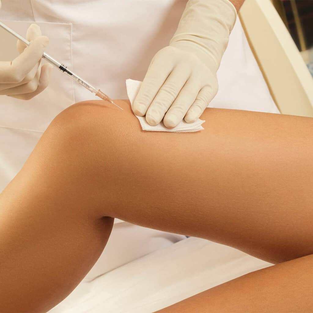 sclerotherapy-raleigh-nc