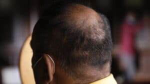 The Role Of PRP In Combating Male Pattern Baldness